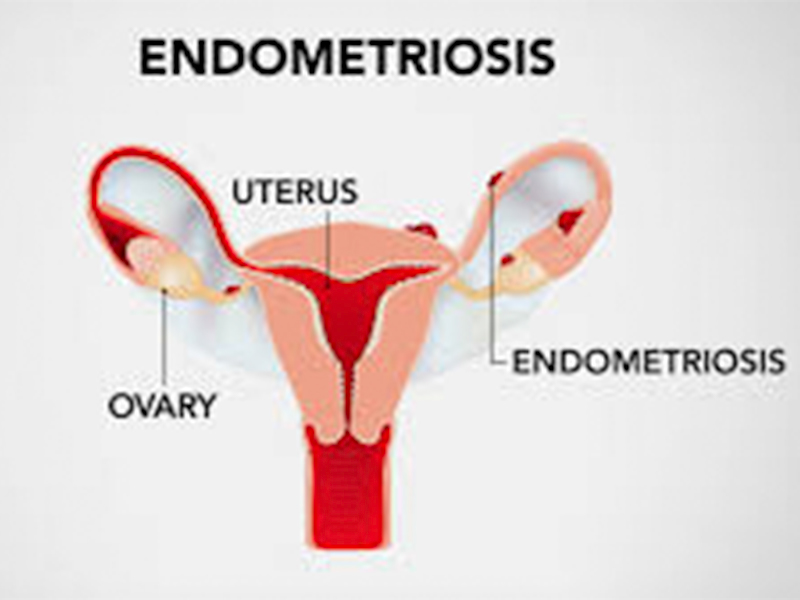 Diagnosis & Treatment of Conditions like PCOS, Endometriosis, and Fibroids in Wagholi