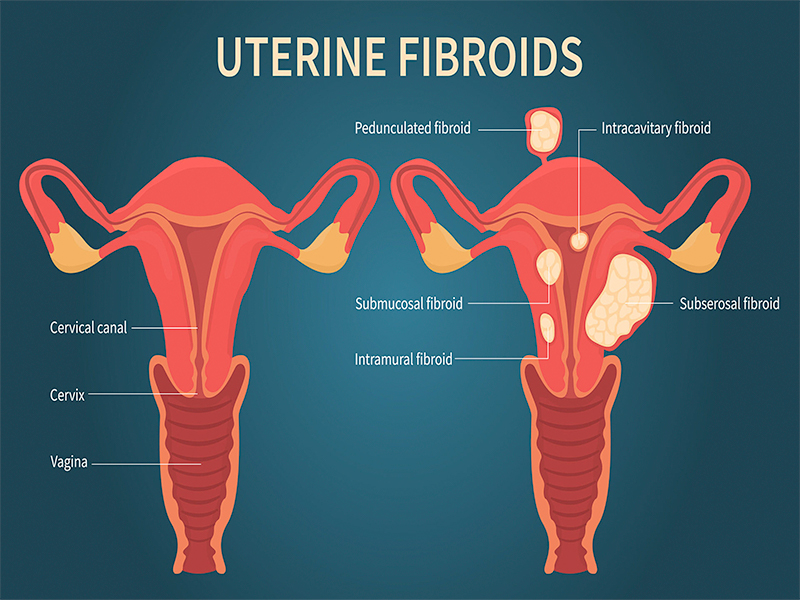 fibroid uterus treatment in Wagholi : Prisha Women's Clinic